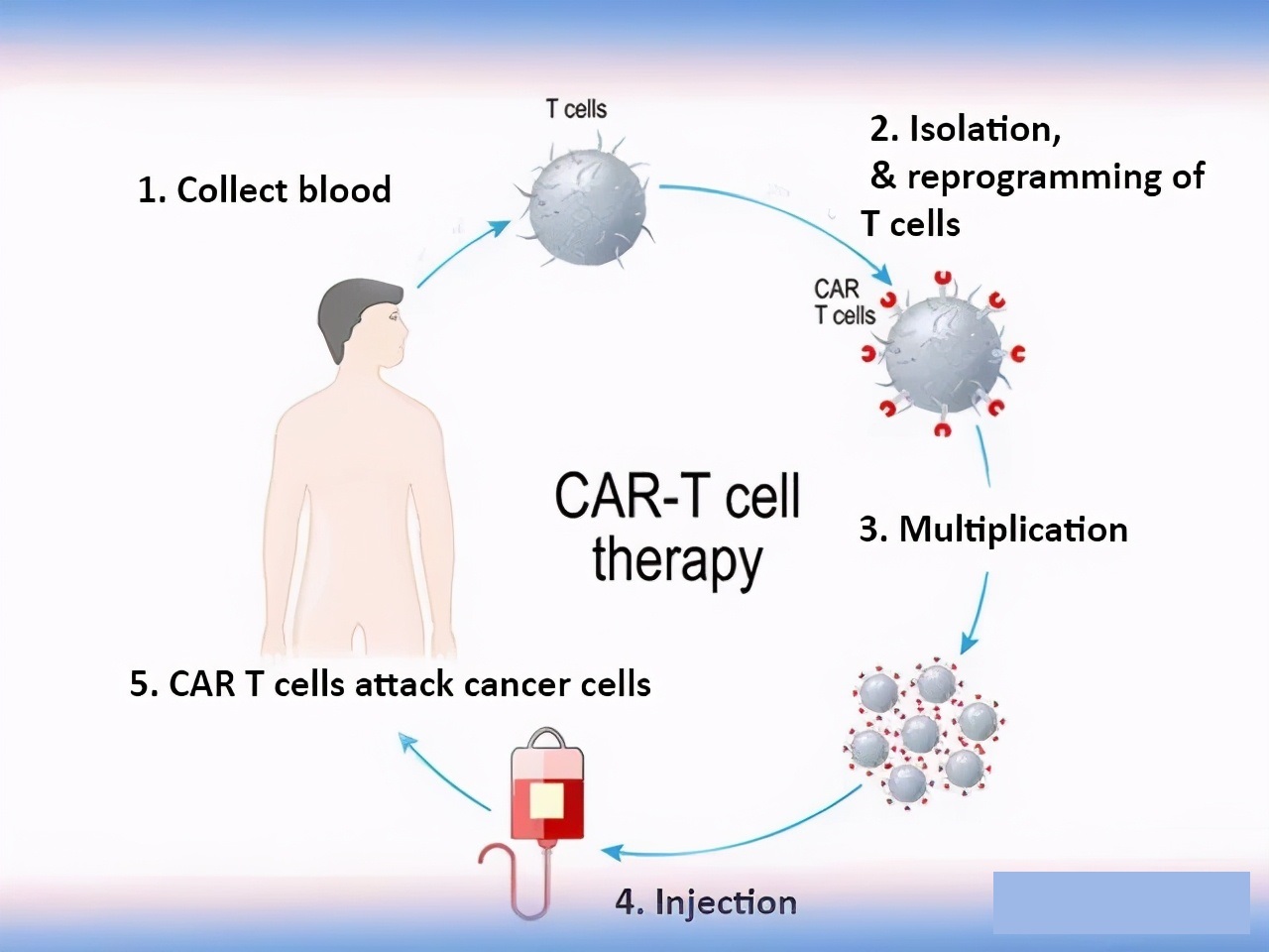 Car-t in the treatment of multiple myeloma