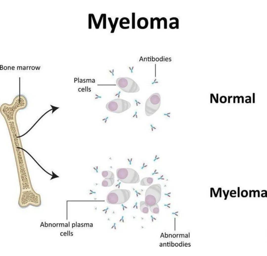 Myeloma