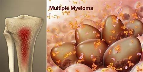 Multiple Myeloma