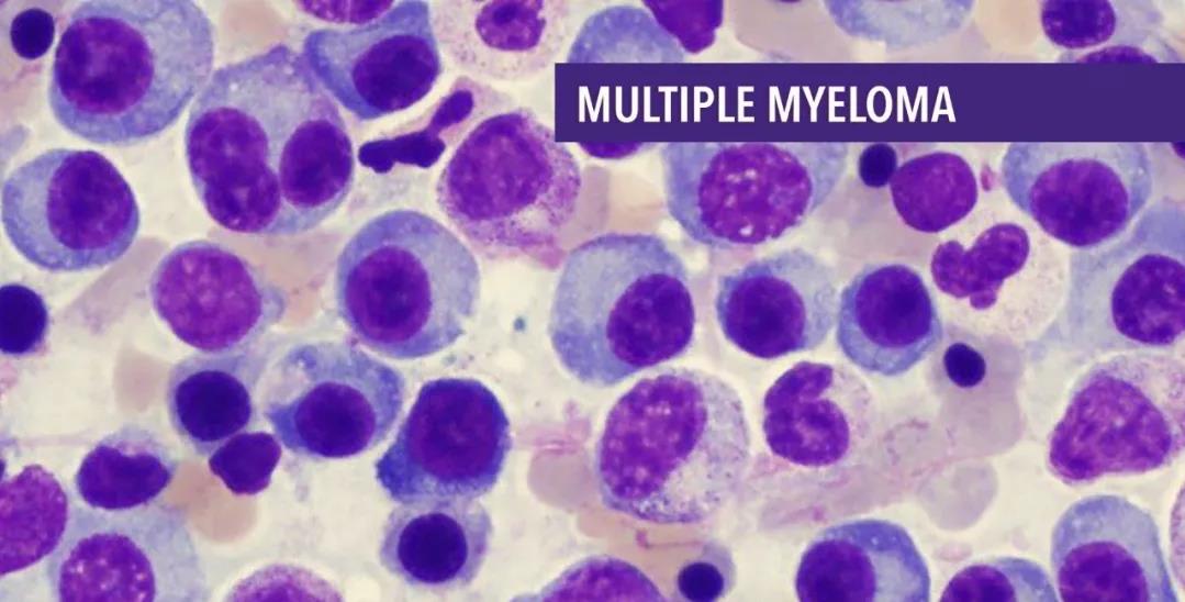 Multiple Myeloma