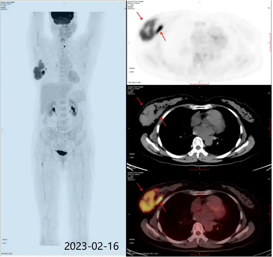 diffuse large B-cell lymphoma(DLBCL)