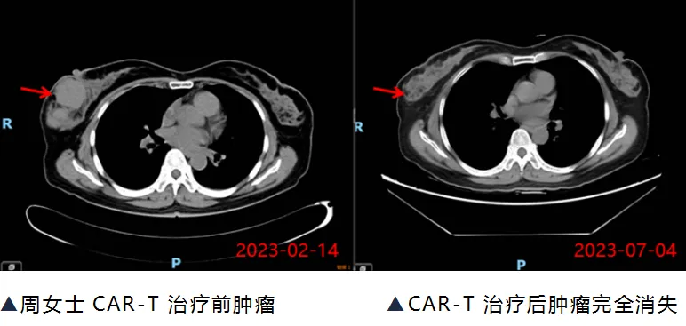 Effect of car-t on DLBCL