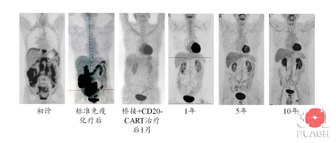 Effect of car-t on lymphoma