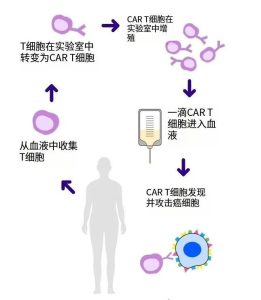 CAR-T cell therapy treatment process