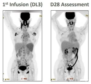 The effect of CTX130 in the treatment of first infusion T-cell lymphoma