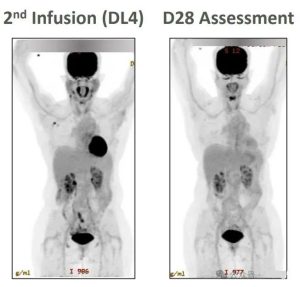 The effect of CTX130 in the treatment of second infusion T-cell lymphoma