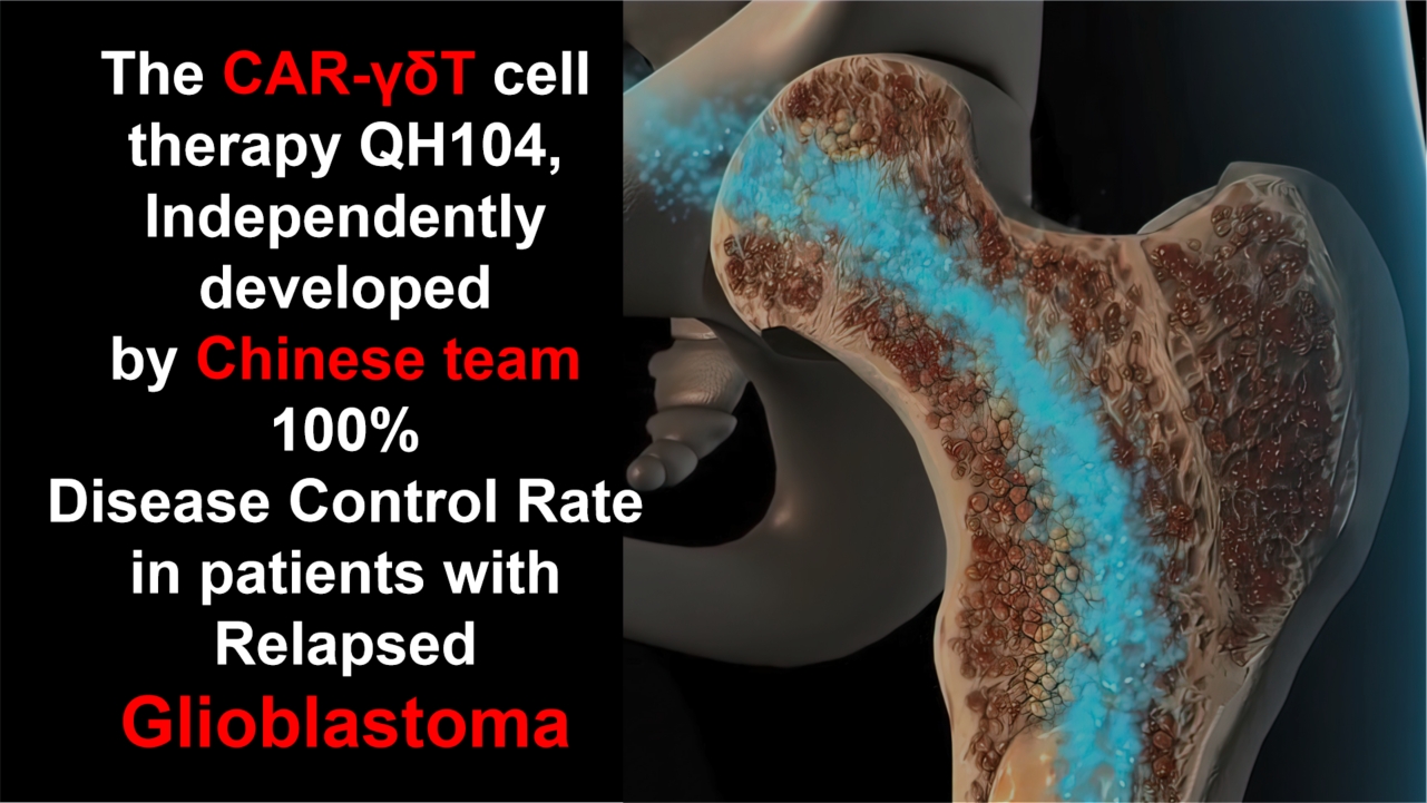 glioblastoma 